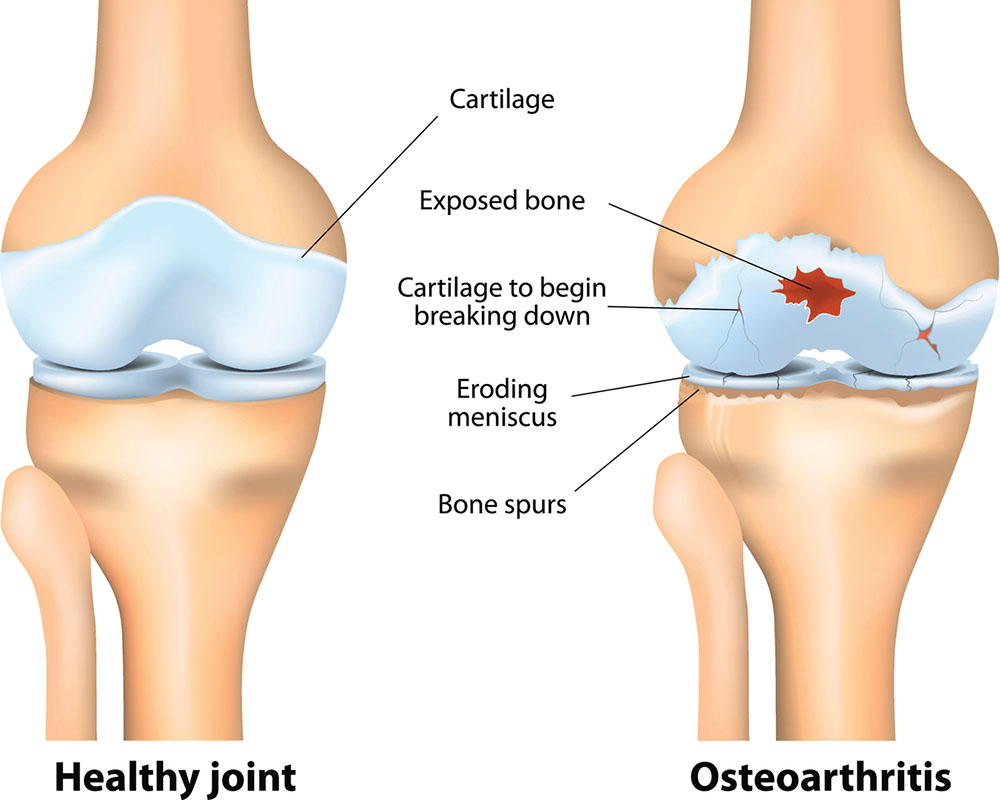 phases-of-osteoarthritis-and-knee-degeneration