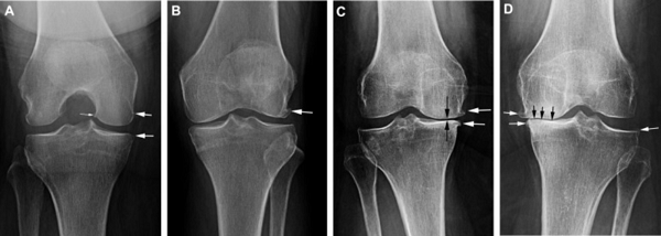 phases-of-oa-and-knee-degeneration