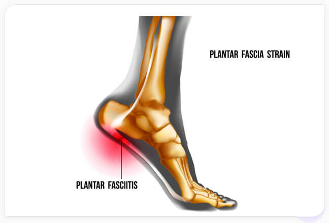 Living with plantar fasciitis? Here is what you need to know