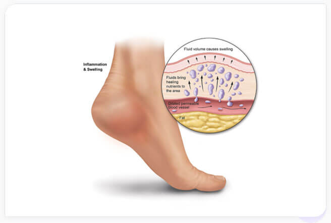 Why does your heel hurt? 2 factors that cause Plantar Fasciitis. — The  Injury Rehab Centre
