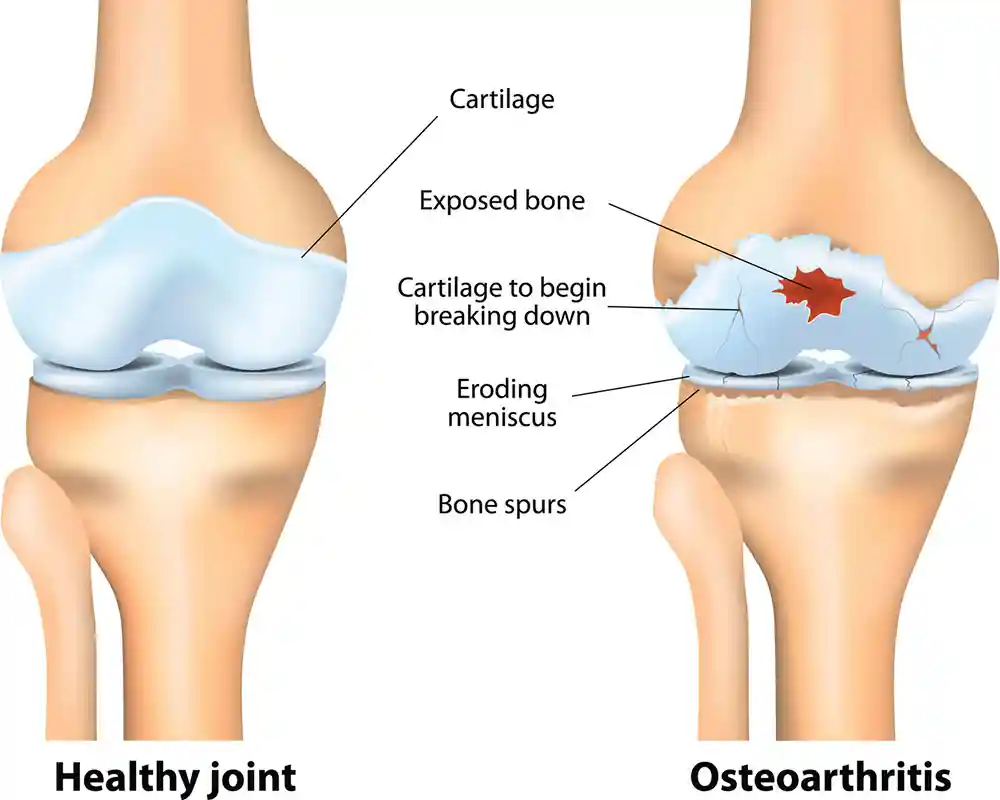 Phases Of Osteoarthritis And Knee Degeneration Diagram showing stages of knee osteoarthritis and joint degeneration
